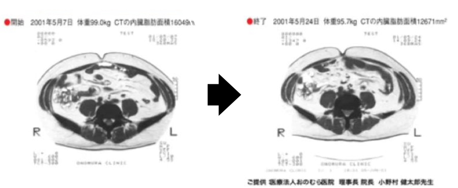 痩身